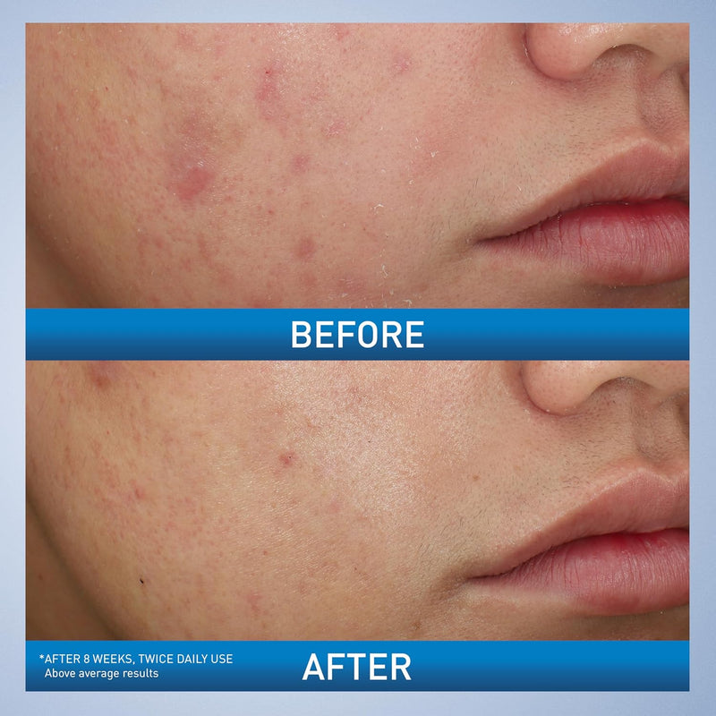 CERAVE Acne Foaming Cream Wash
